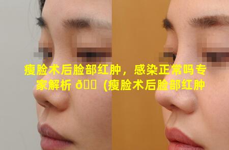 瘦脸术后脸部红肿，感染正常吗专家解析 🐠 (瘦脸术后脸部红肿,感染正常吗专家解析)